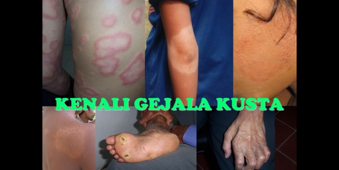 Bercak Putih di Kulit, Mungkin Bukan Panu Tapi Gejala Awal Kusta